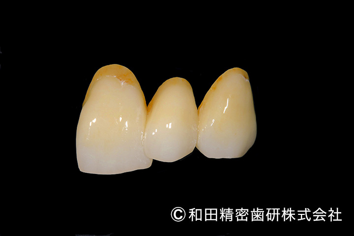 メタルフリー　前歯写真