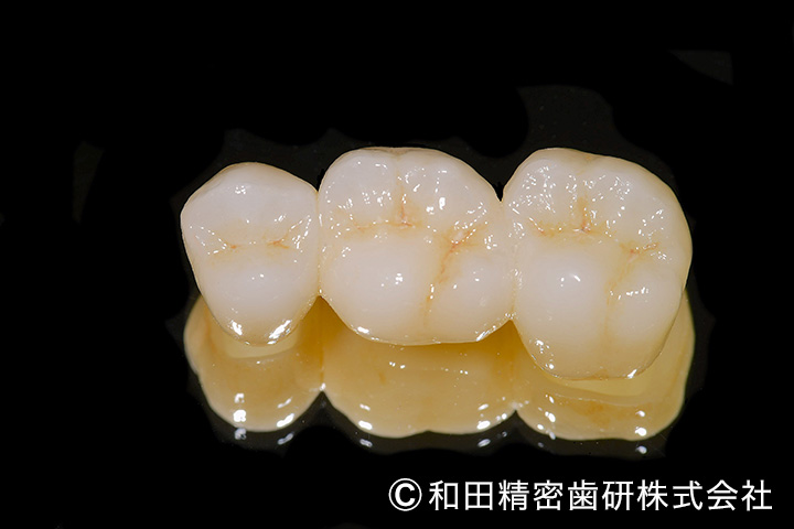 メタルフリー　前歯写真